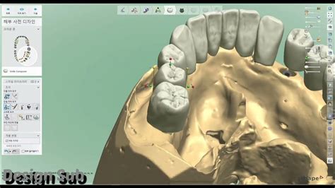 3shape Design Implant Case Full Arch Youtube