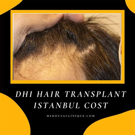 Dhi Hair Transplant Istanbul Cost Medousa Clinique