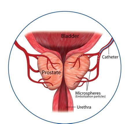 Prostate Artery Embolization Vascular Institute