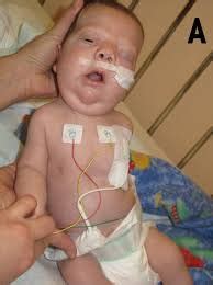 Noonan Syndrome: Causes, Picture, Symptoms And Treatment