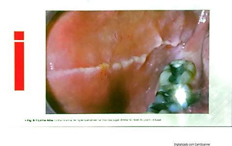 Patologia Bucal Injúrias tecido mole Patologia Bucal