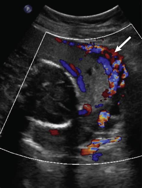 Placenta Percreta Ultrasound