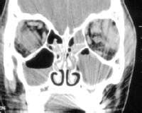 Orbital Subperiosteal Abscess