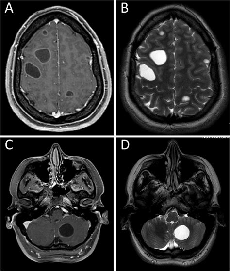 Magnetic Resonance Imaging A Axial Contrast Enhanced T1 Weighted