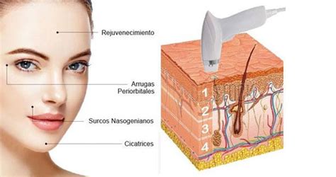 Rejuvenece Tu Rostro Con La Combinaci N De Tecnolog As Ultrasonido