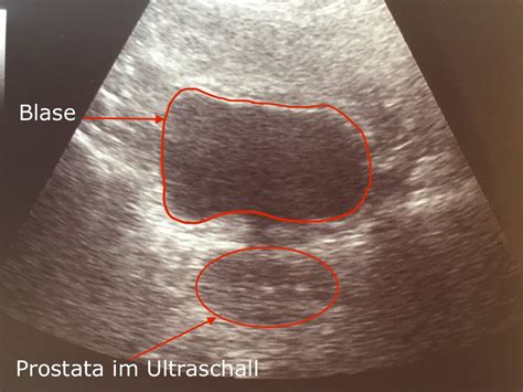 Multiparametric Mri Of The Prostate Alta Klinik