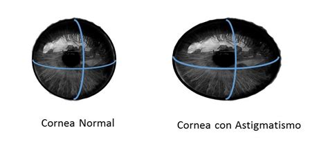 Tiempo Opuesto Eterno Ojo Con Astigmatismo Gimnasio Disgusto Panorama