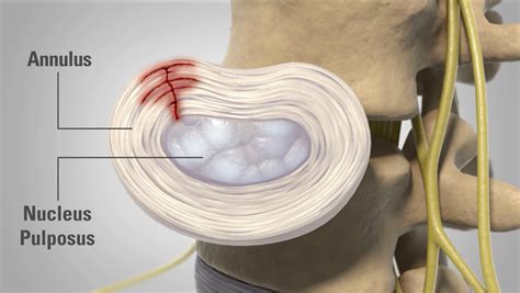 Lumbar Disc Disease - Legacy Spine & Neurological Specialists