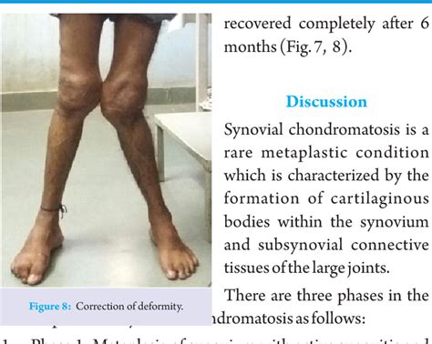 Figure 8 From A Case Report Of Primary Synovial Chondromatosis With