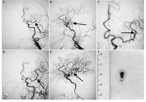 Mechanical Thrombectomy Procedures A Dsa Reveals Persistent L Mca M2