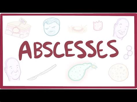 Abscesses - Causes, Symptoms, Diagnosis, Treatment, Pathology - 2024