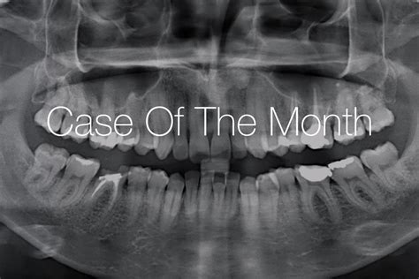 Immediate Implant Placement And Peri Implant Bone Augmentation With