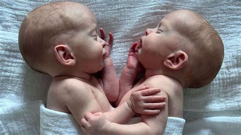 After Four Hours Of Surgery Conjoined Twins Successfully Separated