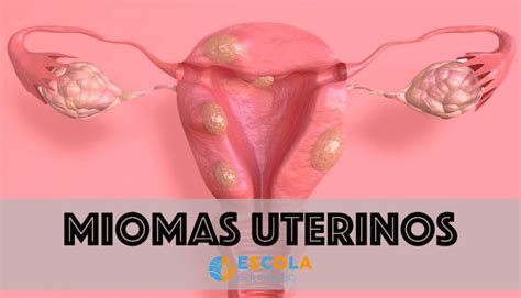 Mioma Uterino O Que São Causas Sintomas Tipos Tratamento