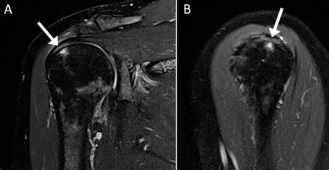 Supraspinatus Rotator Cuff Tear MRI