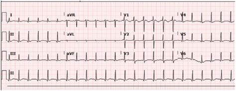 12 Lead Ecg Of The Patient Showing Sinus Tachycardia Download