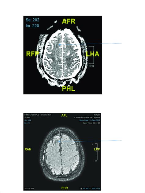 Top Adc Decrease In The Right Frontal Lobe Arrow Bottom Axial Flair Download Scientific