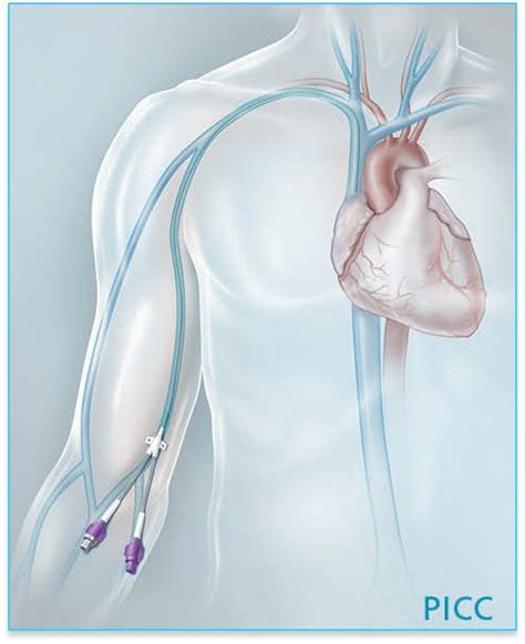 Peripherally Inserted Central Catheter Thrombosis Following Placement