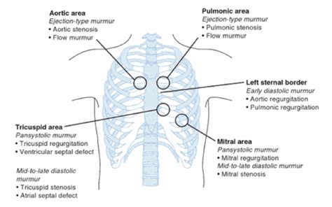 Aortic Regurgitation Murmur