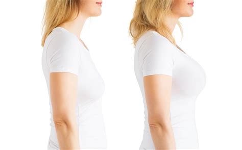 Considering Breast Augmentation Heres What You Need To Know Dr