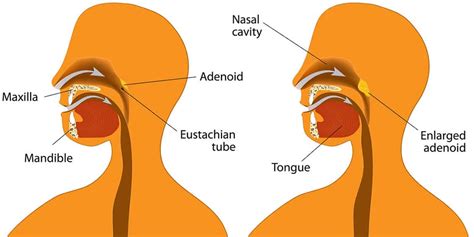 Adenoid Nose