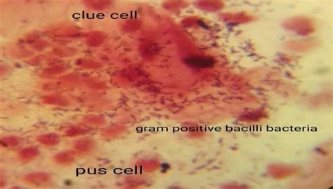 A Bacterial Cells In Smear Preparation Gram Positive With Clue Cells