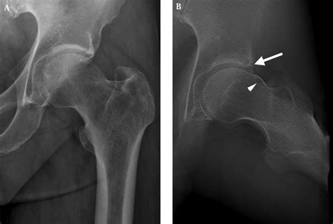 Detection Of Acetabular And Proximal Femoral Radiographic Abnormalities