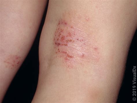 What Does A Shingles Rash Look Like Stages In Pictures Goodrx