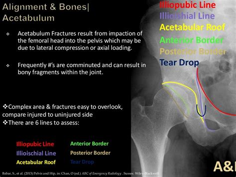 Trauma Image Interpretation Of The Pelvis And Hip Radiographs Using