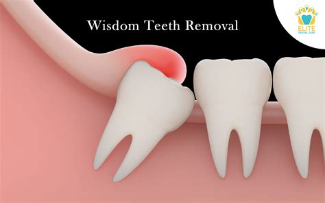 WISDOM TEETH REMOVAL ELITE DENTAL CARE TRACY Elite Dental Care