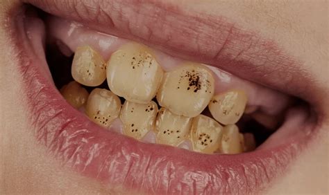 What Causes Black Spots On The Teeth