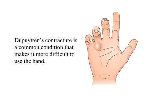 PatEdu.com : Surgery for Dupuytren's Contracture