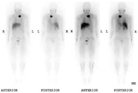 Iodine Metaiodobenzylguanidine Scan Showing Large Focal Region Of