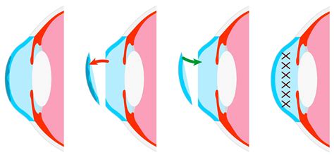 Corneal Transplant Surgery Keratoplasty In Kansas City Mo Discover