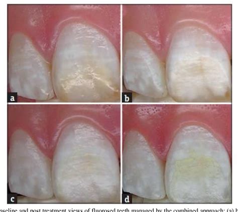 Figure From Comparison Of Enamel Microabrasion With A Combined