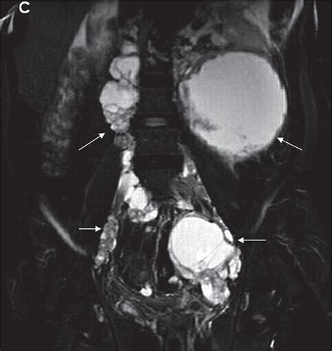 Scielo Brasil Incidental Detection Of Retroperitoneal