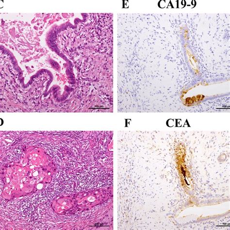 Pathological Findings Of Primary Tumor Of The Liver A Whole Mount