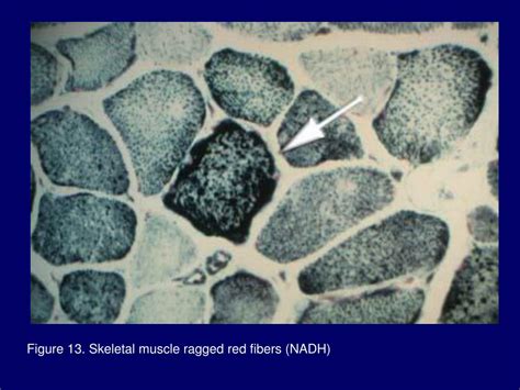 PPT - Mitochondrial Myopathy PowerPoint Presentation - ID:245159