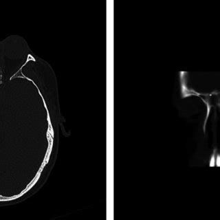 Intraoperative photograph of foreign body found in sphenoethmoidal recess. | Download Scientific ...