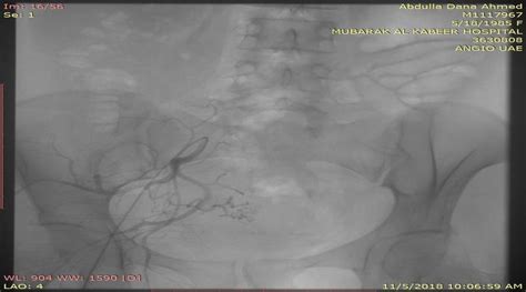 A Embolization Coils Arrow At Thepseudoaneurysm B Selective Left