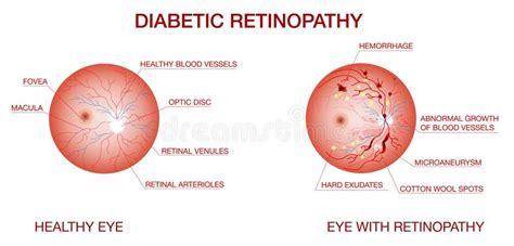 Retinopathy Stock Illustrations 476 Retinopathy Stock Illustrations Vectors And Clipart