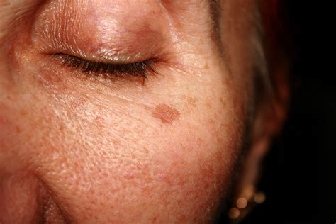 Reversing Sun Damaged Skin Dermatology In Keller Tx