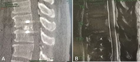 Scielo Brasil Minimally Invasive Lateral Retropleural Approach To