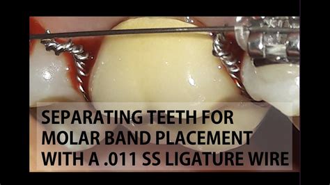 Separating Teeth For Band Placement Using A Stainless Steel