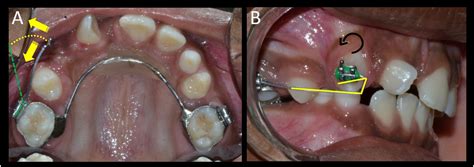 Orthodontic Correction Of Maxillary Canine Lateral Incisor