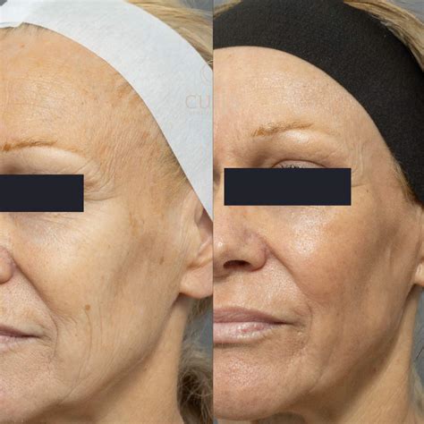 Co2 Laser Resurfacing Cutis Dermatology