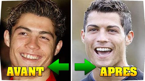 Top 13 Des Stars Avant Apres La Chirurgie Cristiano Ronaldo Tom