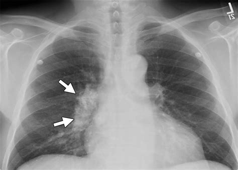 Amyloidosis Modern Cross Sectional Imaging Radiographics