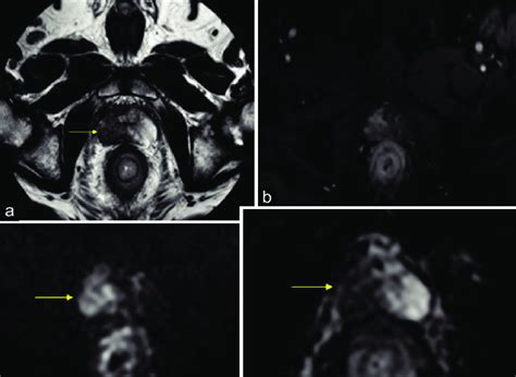 multiparametric magnetic resonance imaging prostate (a) PIRADS 5 lesion ...