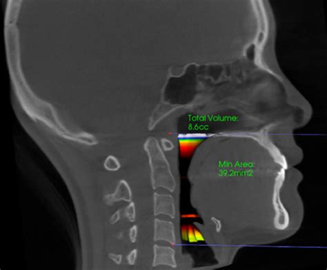 Sequential Changes In Pharyngeal Airway Dimensions After Mandibular